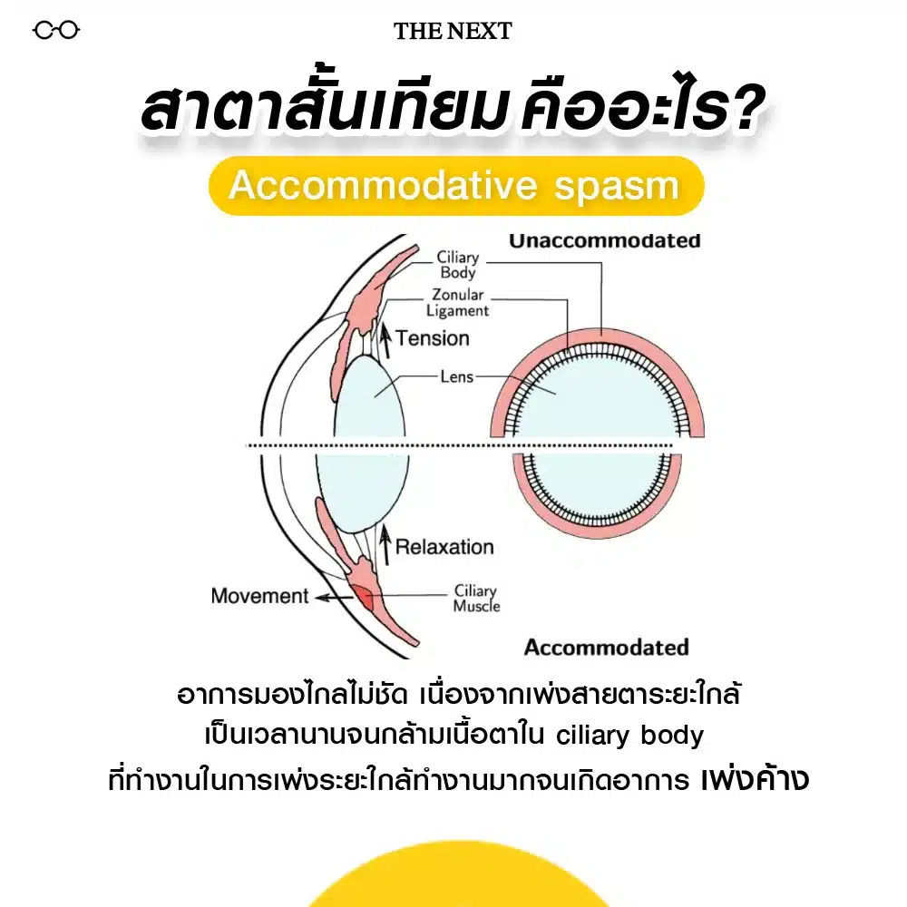 สายตาสั้นเทียมคืออะไร ?
