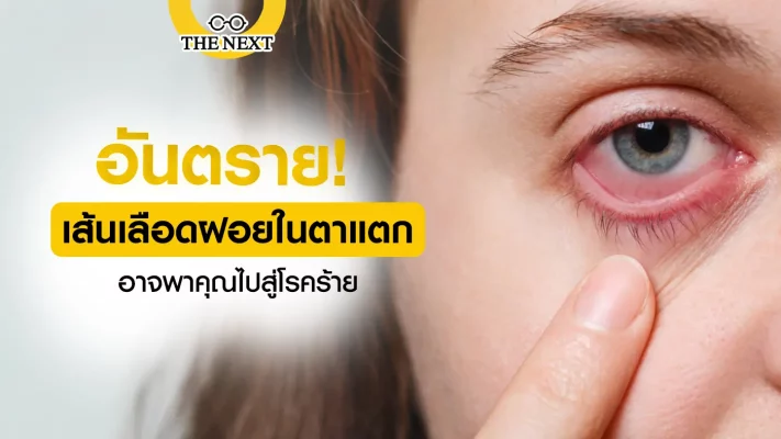 อันตราย เส้นเลือดฝอยในตาแตก